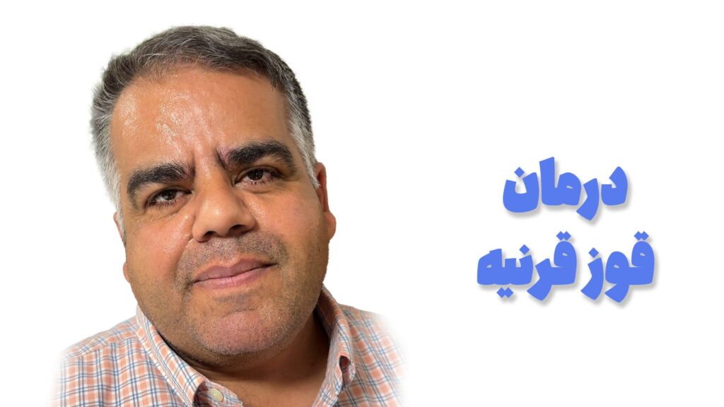 تجربه بیمار از درمان قوز قرنیه در مدوپی
